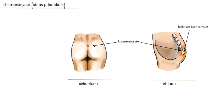 Hinder opening Met name Proctos Kliniek - Haarnestcyste (sinus pilonidalis)